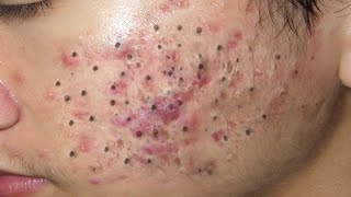 Blackhead Removal With Sac Dep Spa @1000300