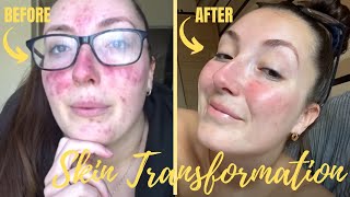 SKIN TRANSFORMATION- ACNE AND ROSACEA, WHAT WAS CAUSING THIS...//LAUREN MEE