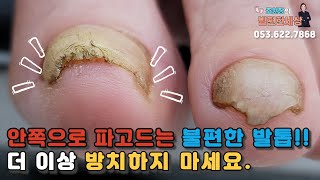 파고드는 발톱 방치는 놉!!! #대구내성발톱 #대구무좀발톱 #문제성발 #fungal #toenails