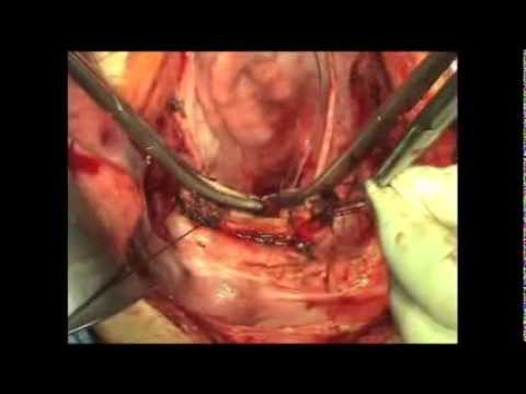 Total Abdominal Hysterectomy | Atlas of Gynecologic Surgery