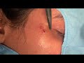 Treatments for ACNE SCAR | Dermabrasion and fine plasticsurgery