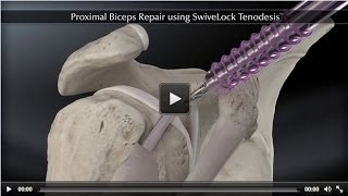 Proximal Biceps Repair Using Swivelock Tenodesis