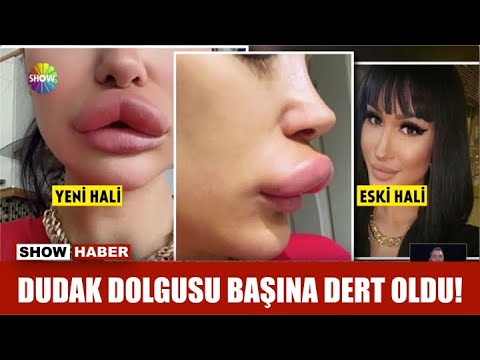 Dudak dolgusu başına dert oldu!