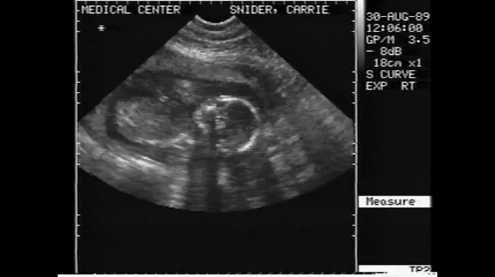 Randy Snider's Ultrasound - August 30, 1989