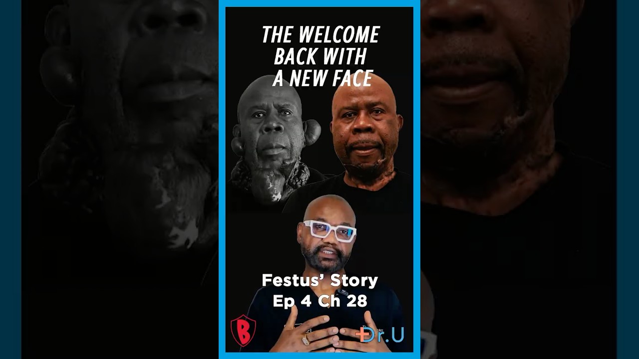 Festus Returns After His Keloid Treatment Journey | Dr. U