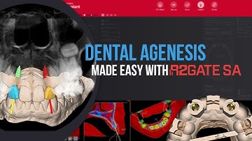 R2GATE SA Tutorial Series | Clinical 1 : 🦷⚙️ How R2Gate SA Simplifies Dental Agenesis Cases