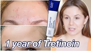 One Year Tretinoin/Retin-A Update: My acne CAME BACK, before & after, & moving up in strength