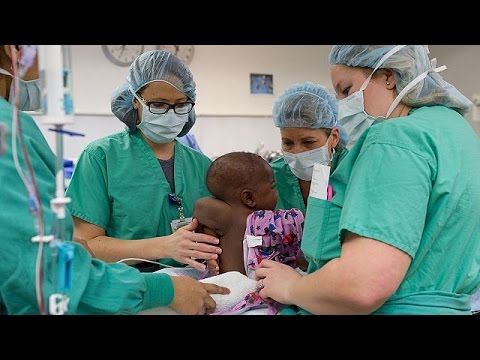 Vídeo: Eles Operam Em Um Bebê Que Tinha Um Gêmeo Parasita