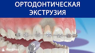 Ортодонтическая экструзия ©
