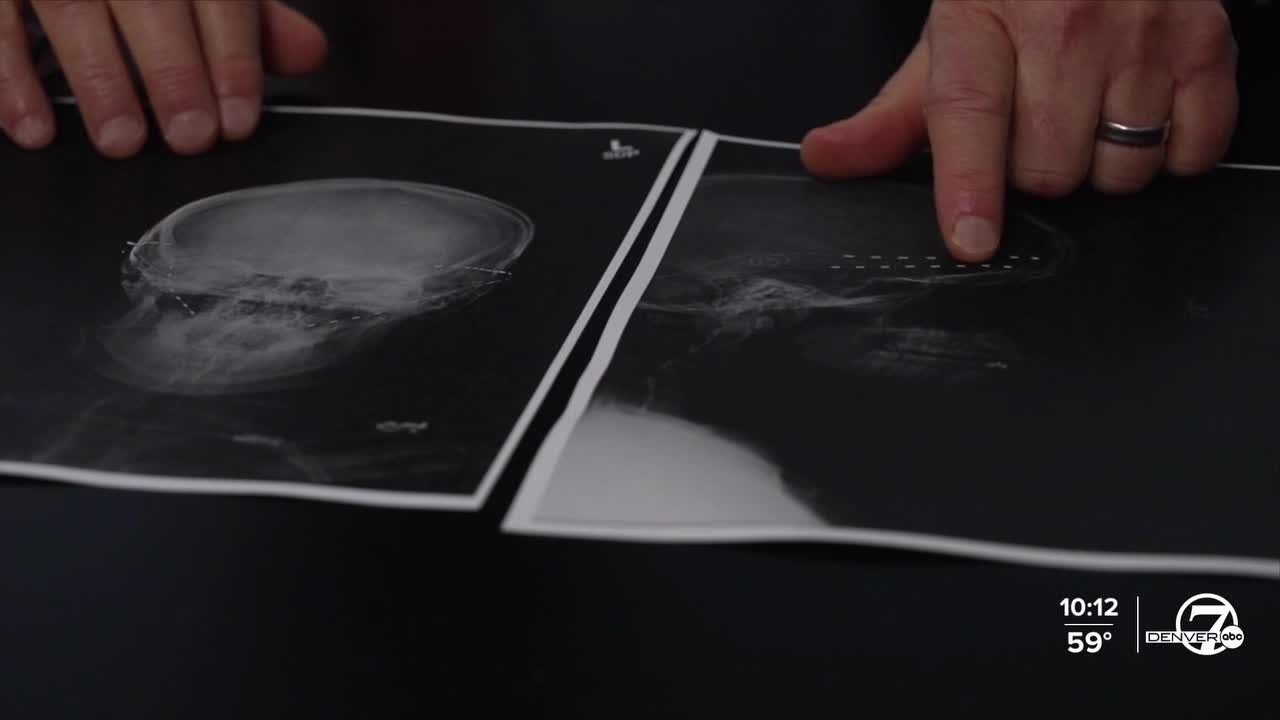 Migraines are hard to treat. One Colorado doctor is hoping to make it easier