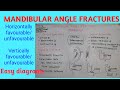 Mandibular angle fractures