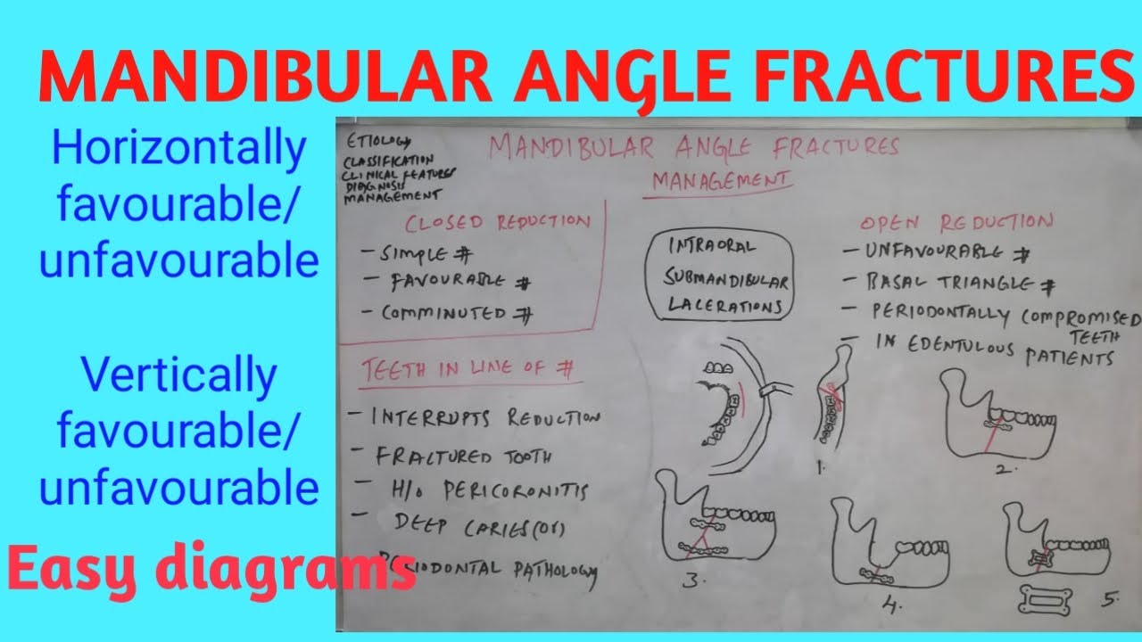 Mandibular Fracture Classification