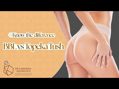 Butt Augmentation using Fat Grafting and Results | Brazilian Butt Lift (#BBL) vs #Topeka Tush