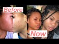 How I cleared my skin (only 3 products)