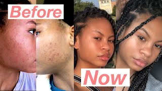 How I cleared my skin (only 3 products)