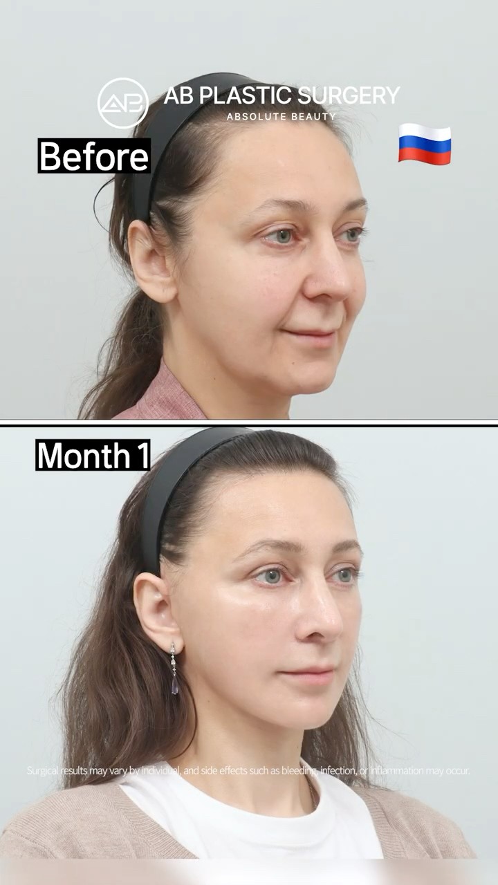 Her DeepPlaneFacelift Transformation ✨ #Shorts