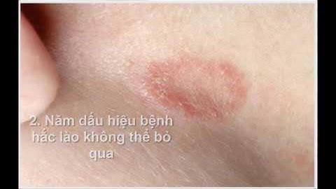 Bệnh Hắc Lào (Lác Đồng Tiền) Là Gì, Dấu Hiệu Bạn Bị Bệnh Hắc Lào (Lác Đồng Tiền)