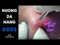 #053 | Treat acne for a nice girl | Being recorded before Social distancing