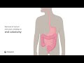 Creation of end colostomy by removing rectum and anus  ostomy surgery  coloplast india