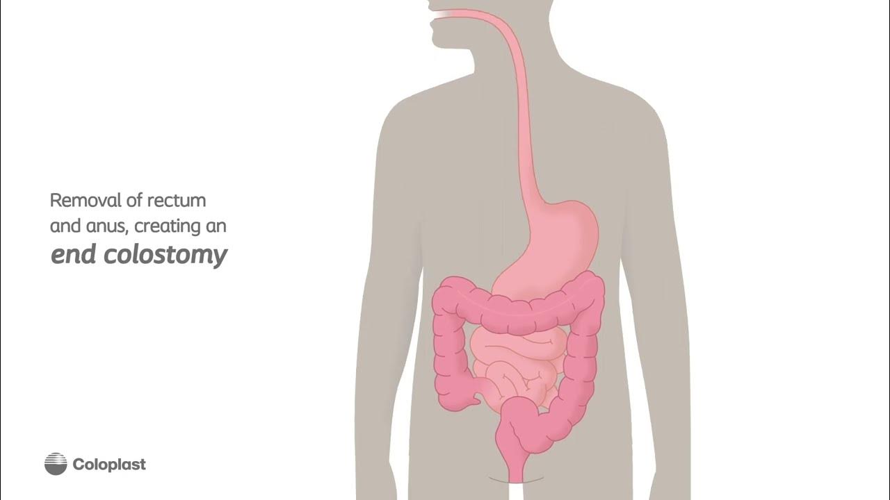 creation-of-end-colostomy-by-removing-rectum-and-anus-ostomy-surgery