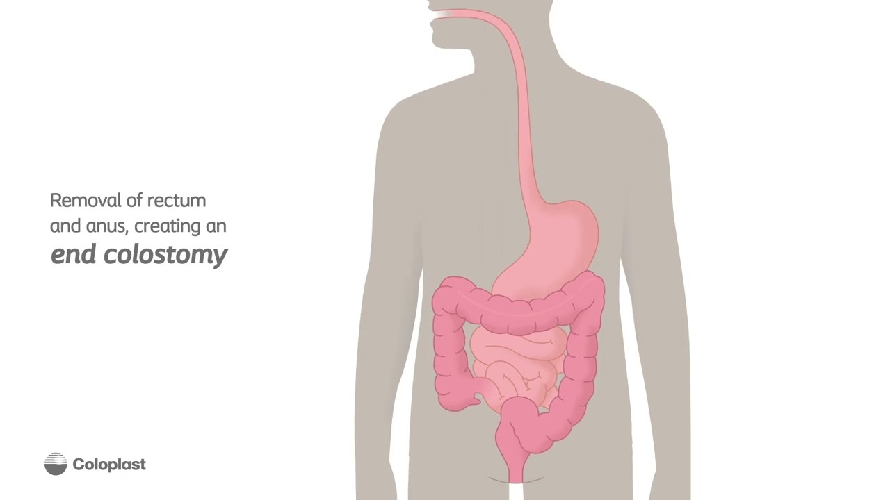 Creation Of End Colostomy By Removing Rectum And Anus Ostomy Surgery Creation Of End Colostomy By Removing Rectum And Anus Ostomy Surgery