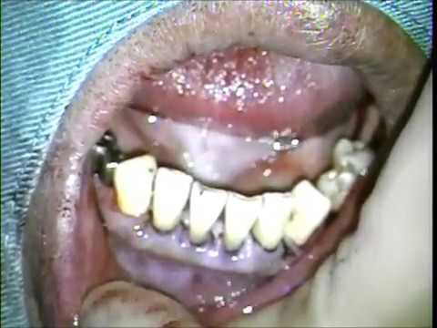 gingival curettage