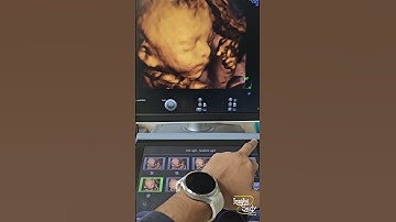 Fetal Face 3D Tutorial || Ultrasound