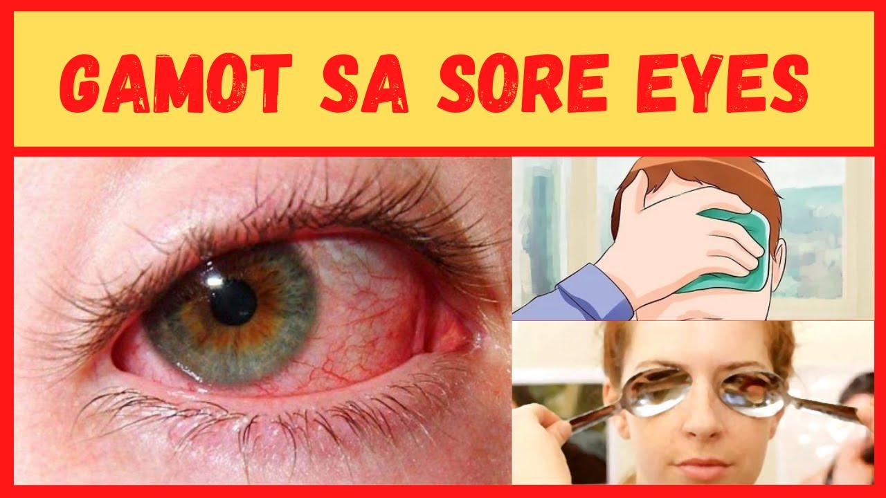 SORE EYE, ITO ANG GAWIN MO AT EPEKTIBO