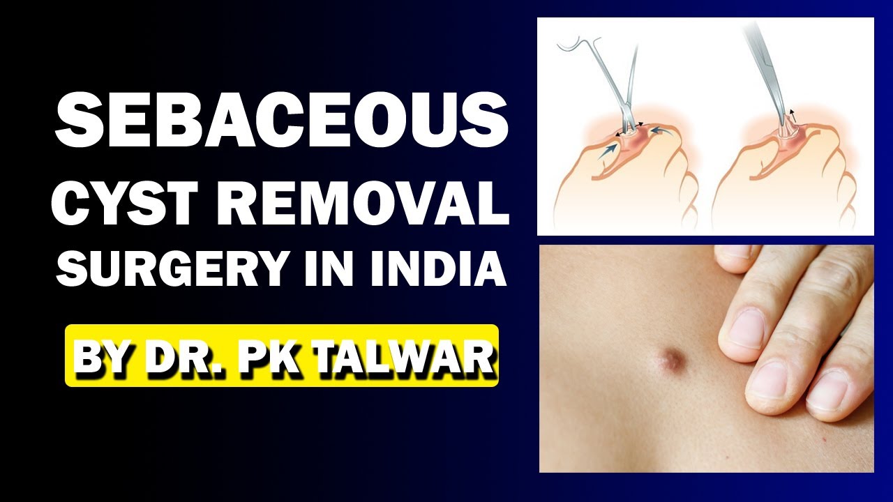 Sebaceous Cyst Removal Surgery In Delhi India By Dr Pk Talwar Best