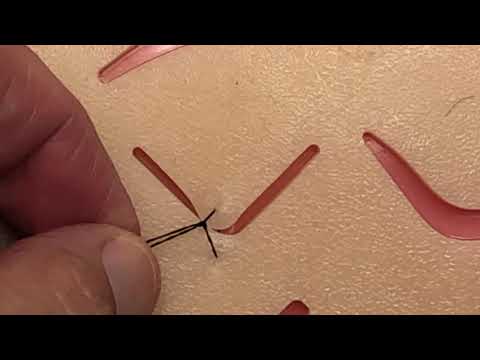 Laceration Repair Time Limit