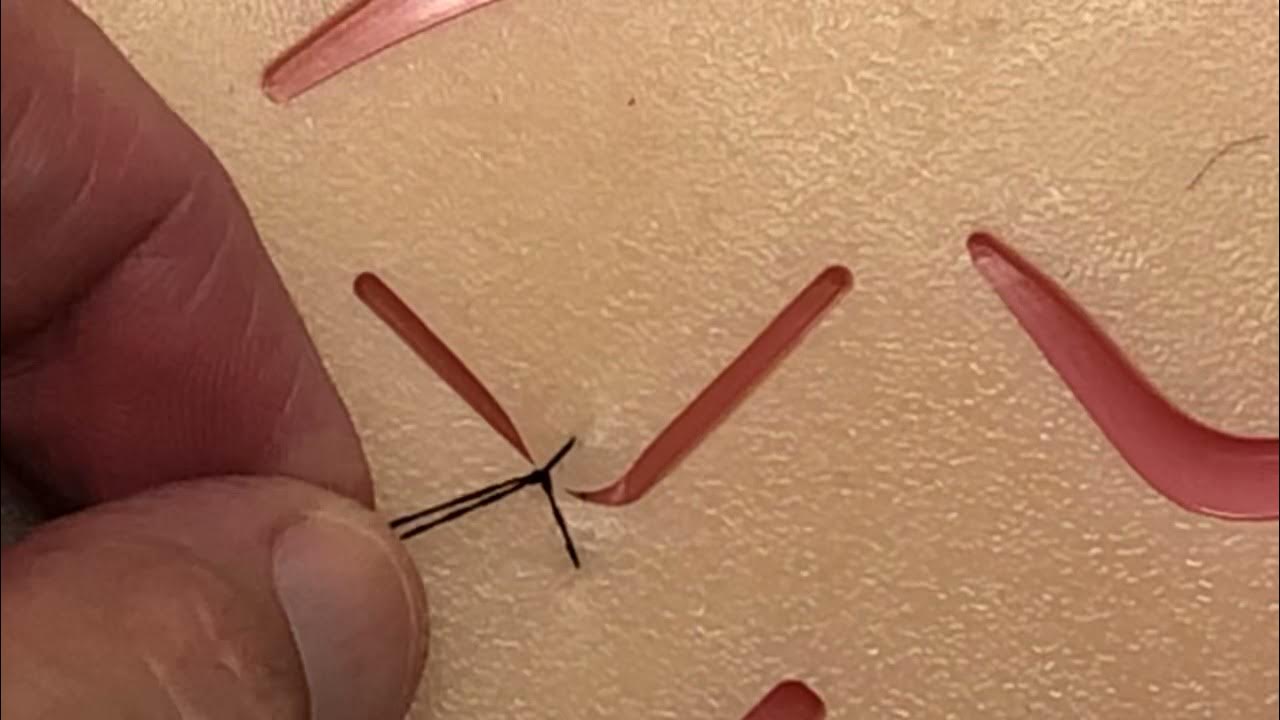 Vshaped laceration repair YouTube