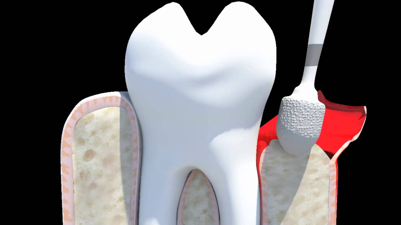 Dental Service Gum Flap Surgery YouTube