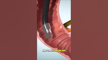 Endoscopic Retrograde Cholangiopancreatography  #3danimation #endoscopic #retrograde #health #pain