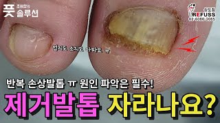 무릎 다친이후, 반대쪽 문제성발톱이 심해진 고객님ㅠ, 약먹고 관리해도 좋아지지 않는 이유가 궁금해 조원장 찾아오셨어요 조원장의풋솔루션 레푸스상도점 문제성발관리 refuss