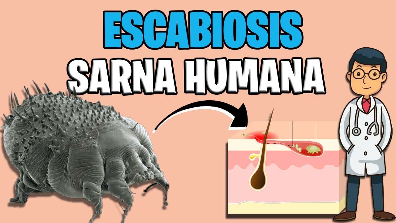 SARNA HUMANA  ESCABIOSIS sintomas TRATAMIENTO 2023  Sarcoptes Scabiei  