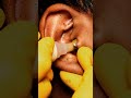 Extreme Comedone Removal on Ear 👂 | Macro Skincare ASMR