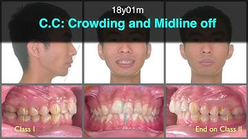 Treatment of Skeletal Class II Malocclusion with Invisalign｜【Chris Chang Ortho】CC798
