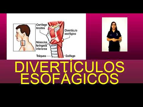 Video: 3 formas de diagnosticar el divertículo esofágico