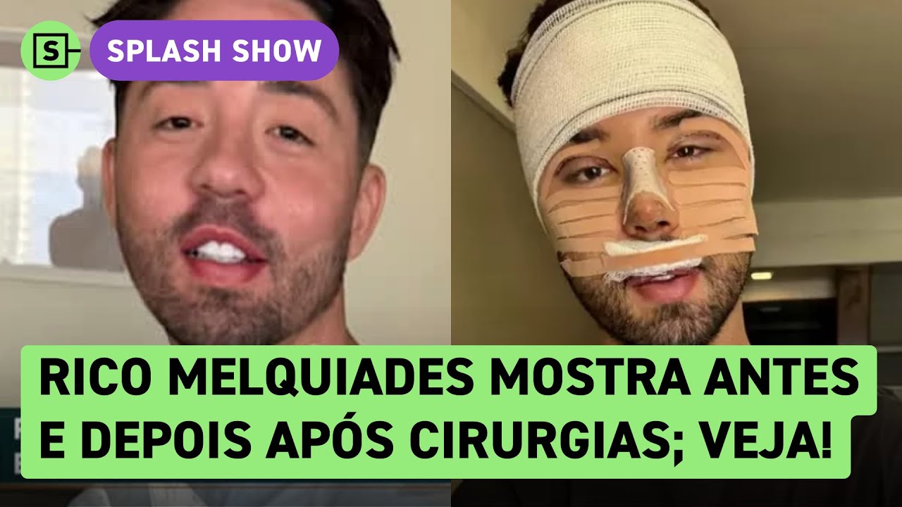 Rico Melquiades mostra resultado de cirurgia plástica que custou R