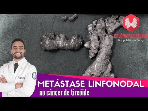 Vídeo: Metástases Tireoidianas - Câncer Papilar De Tireoide