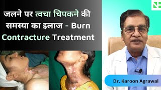 जलने पर त्वचा चिपकने की समस्या का इलाज - Burn Contracture Treatment in Hindi | Dr Karoon Agrawal