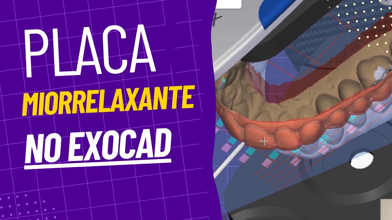 Aprenda a desenhar Placa Miorrelaxante no Exocad + Configuração de Parâmetros.