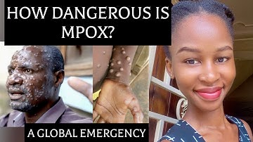 Monkeypox (Mpox) Virus: Transmission, Signs & Symptoms, Prevention, Vaccination & Treatment|Outbreak