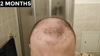 My 2 Hair Transplants Results Timeline | Before and After