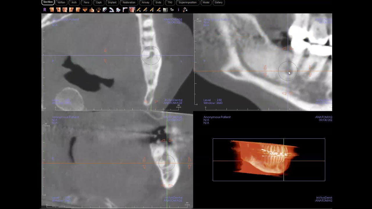 Recurrent OKC (Odontogenic keratocyst) confirmed!