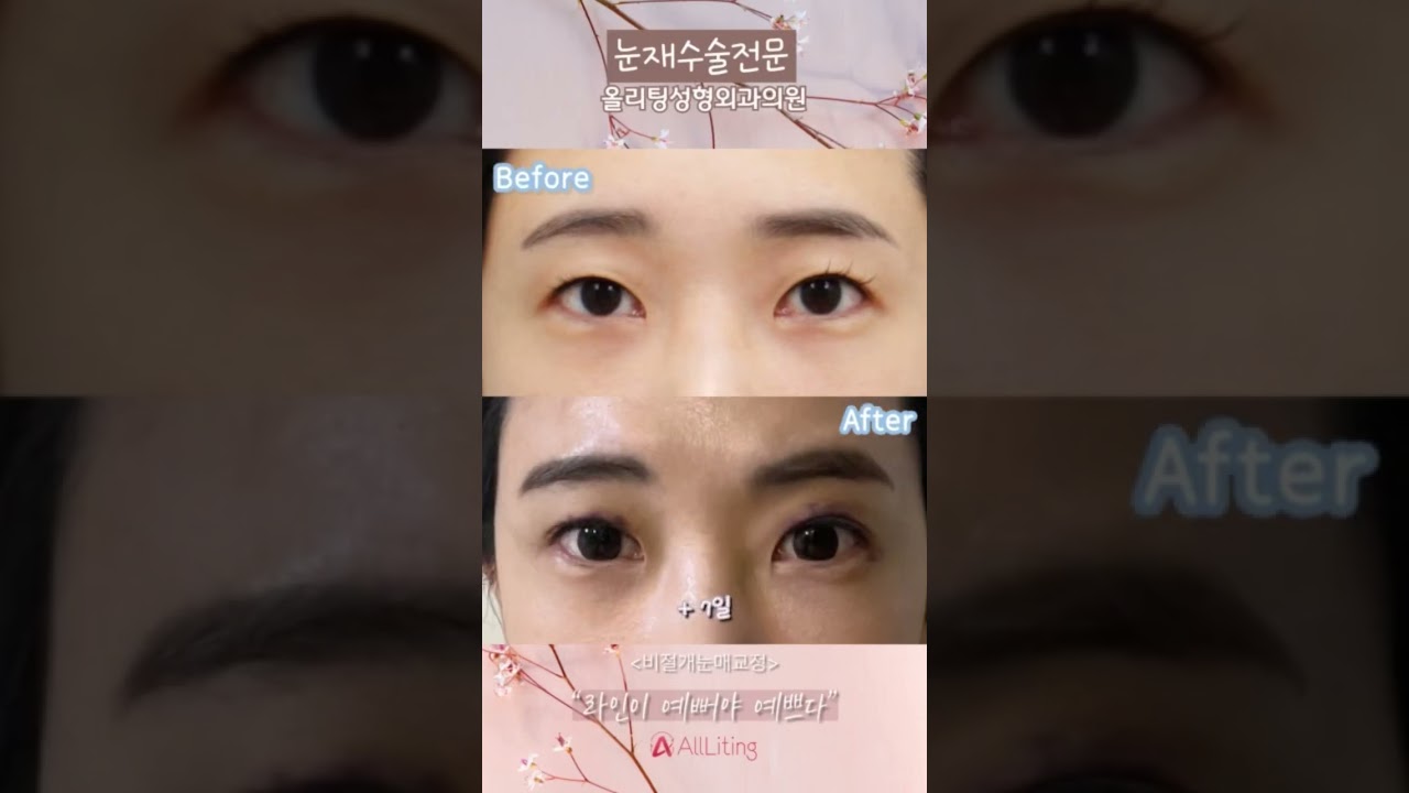 [Phòng khám phẫu thuật thẩm mỹ Ollitine] Bạn hỏi có phải tái phẫu thuật mắt luôn phải bằng phương pháp #phẫu_thuật_mắt_rạch_mở không? Không phải đâu nhé😎 Tại #Phòng_khám_phẫu_thuật_thẩm_mỹ Ollitine, chúng tôi có thể tái phẫu thuật mắt bằng cả phương pháp #phẫu_thuật_mắt_không_rạch_mở đó nha❤️#chỉnh_hình_mắt #tái_phẫu_thuật_mắt_hai_mí #nơi_phẫu_thuật_mắt_giỏi #Gangnam