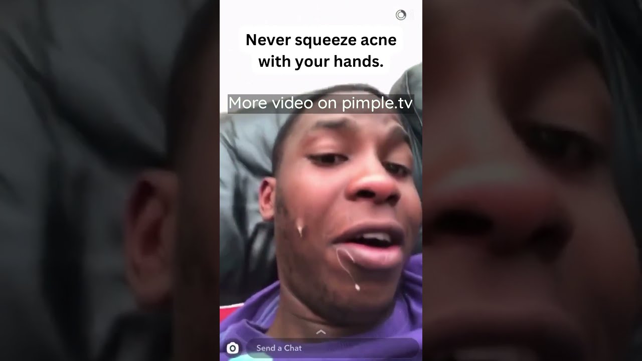 Never Squeeze Acne With Your Hands 