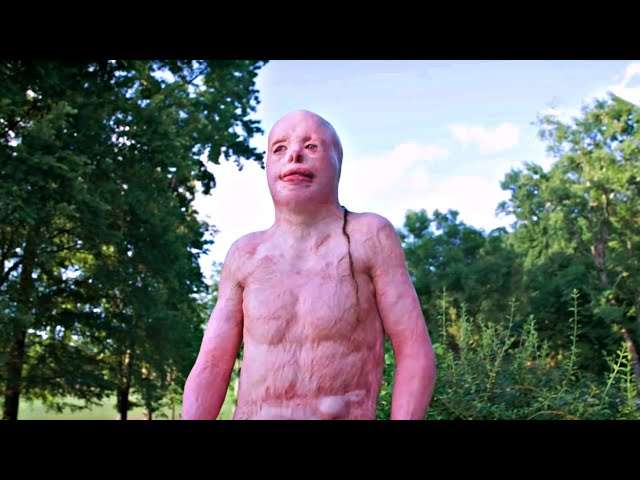 КАК Я ОБГОРЕЛ на 95% и выжил