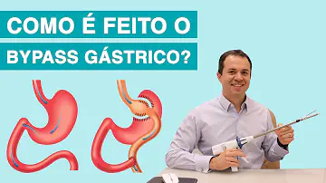 Como é feito a bypass gástrico?