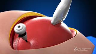 Dr. Robin Bowman: training surgeons with a fetoscopic spina bifida surgical simulation model